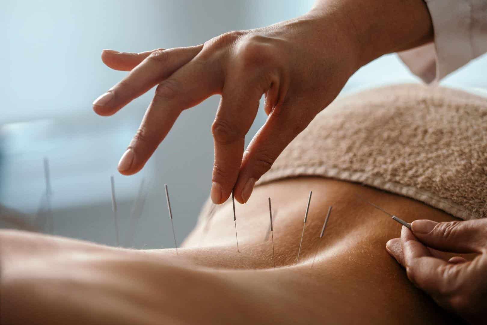 5 Surprising Benefits Of Dry Needling