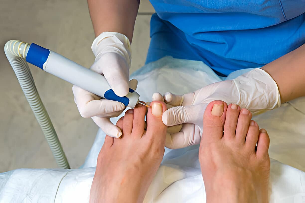 Ingrown Toenails